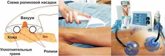 Вакуумно-роликовый массаж. Техника